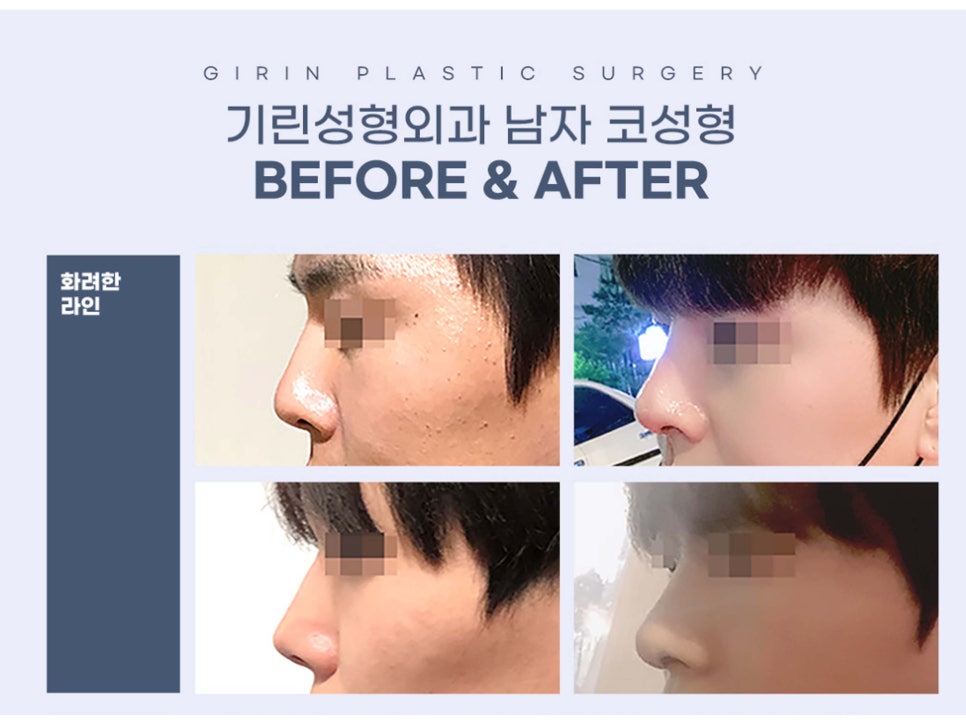 남자코수술전후 주의해서 선택을 관련 이미지 6