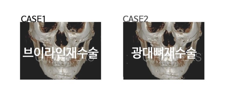안면윤곽재수술 시 고려해야 할 점 관련 이미지 3