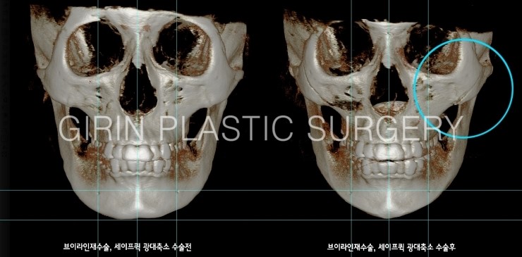 귀뒤사각턱 재수술사례 관련 이미지 1