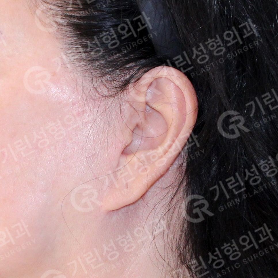 [기린성형외과의원] 누운귀 칼귀 작은귀 고민 해결_엘프귀 요정귀 귀필러 관련 이미지 8