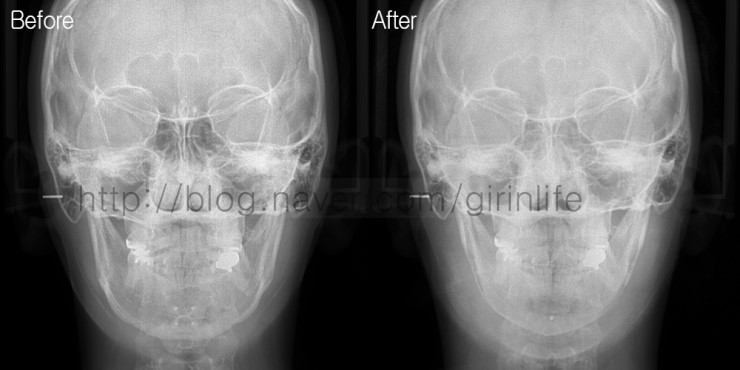 사각+앞턱을 했지만 효과가 떨어지는 경우 재수술사례 관련 이미지 3