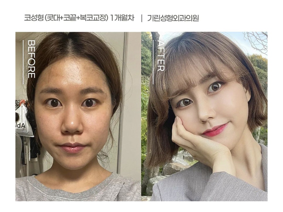 복코수술후기 제대로 찾아야 하는 이유는 관련 이미지 5