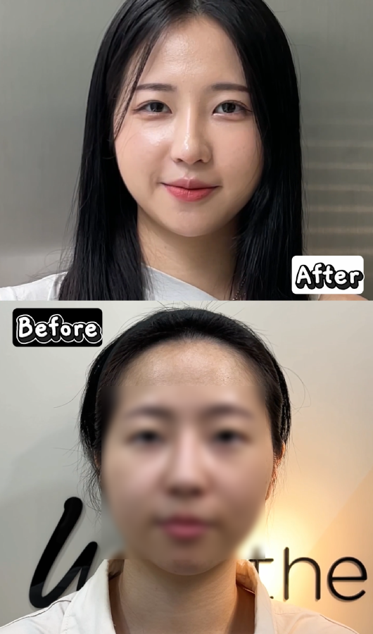 강남역 근처 쌍꺼풀 잘하는 곳 어디? 생생한 후기 관련 이미지 11