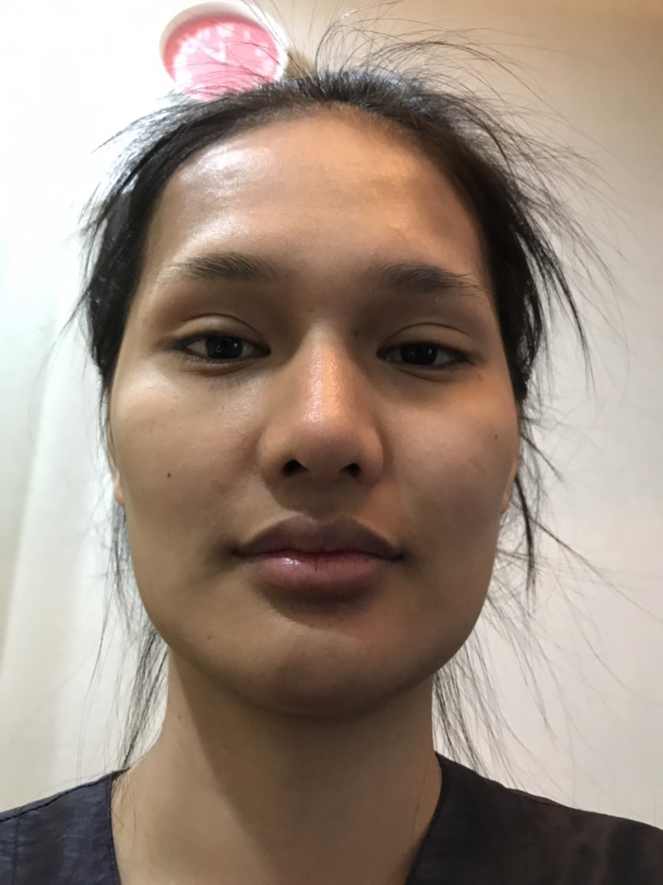 [사각턱축소 최다수술 이승룡원장] 태국에서 온 그녀의 윤곽 수술 후기 리얼 스토리&hearts; 관련 이미지 2