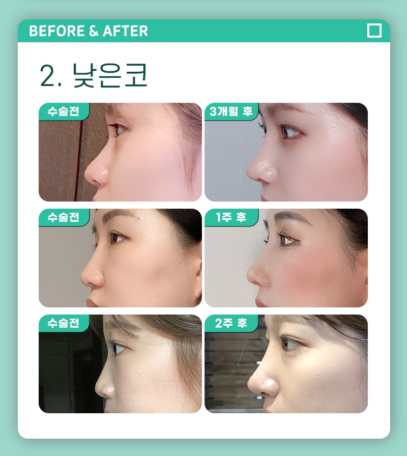 코성형수술비용 확실한 기준으로 정확하게 관련 이미지 2