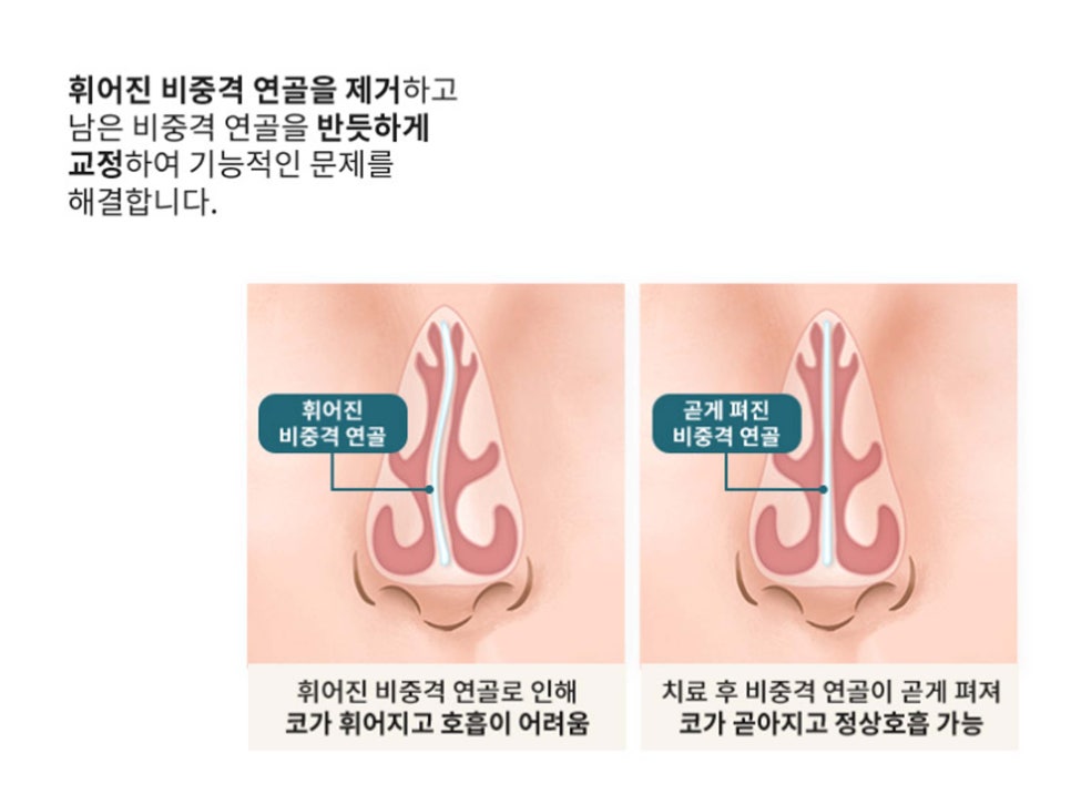 강남기능코성형 원인과 필요성 생각하여 관련 이미지 9
