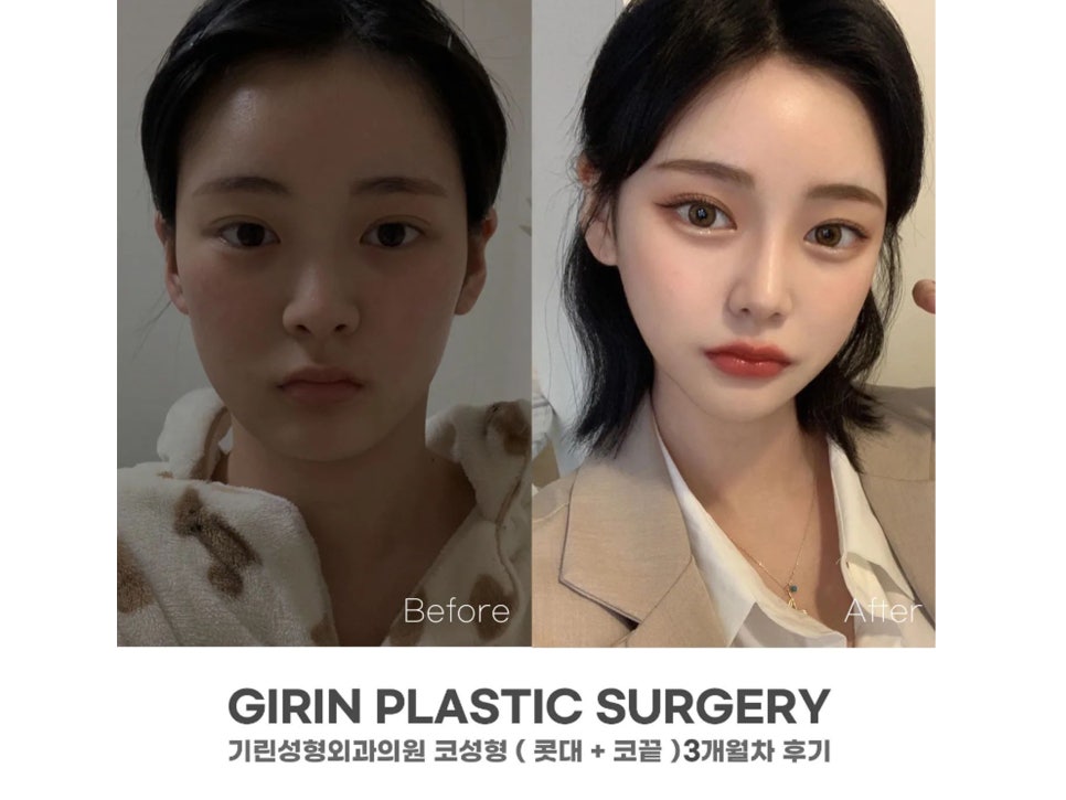 논현성형외과 낮은 콧대 고민은 관련 이미지 9