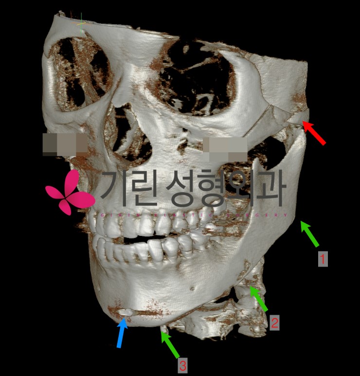 CT로 판단하는 광대축소 결과 관련 이미지 2