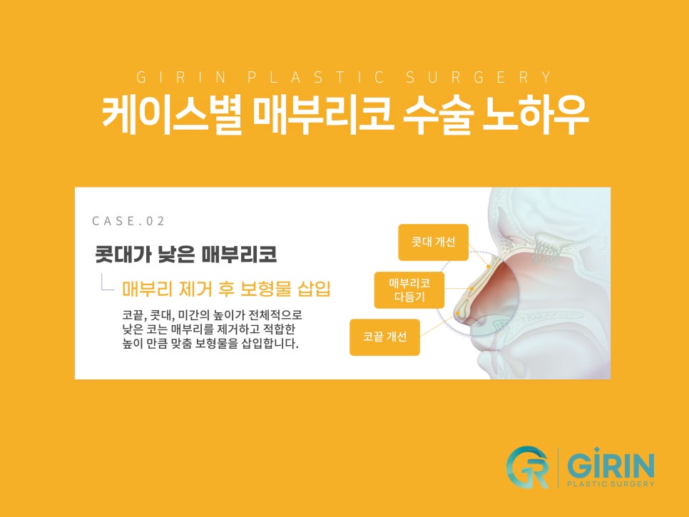 여자코성형후기 얼굴 비율까지 고려하여 관련 이미지 11