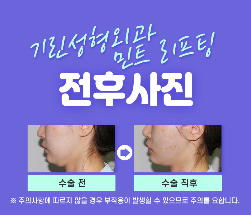 한시간의 즉각적인 효과를 원한다면 1day 민트리프팅:D 짧은줄 관련 이미지 8