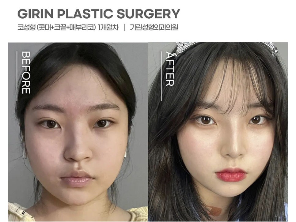 논현성형외과 낮은 콧대 고민은 관련 이미지 11