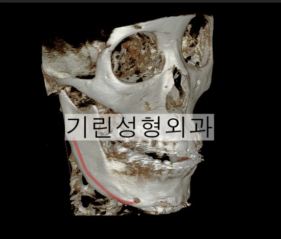 효과없는 브이라인수술 (수술 후 U라인) 관련 이미지 2
