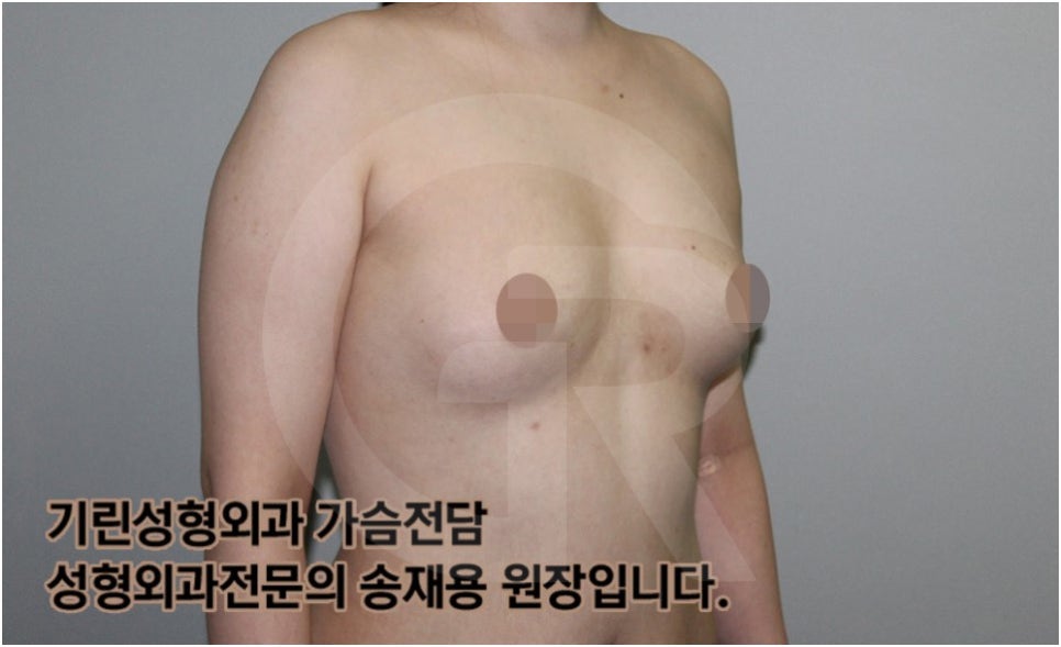 가슴확대수술 후 관리방법, 실제사례 알아보다. [기린성형외과의원_Dr.송재용] 관련 이미지 2