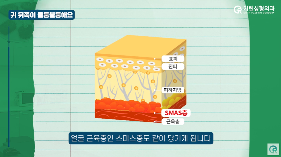 [기린성형외과] 부기 빼려다 화상까지?_안면거상 수술 후 부작용과 주의사항 Q&A 관련 이미지 13