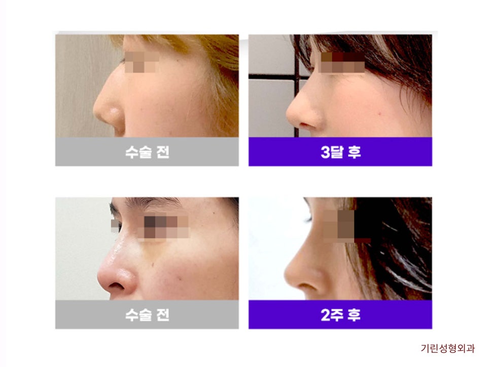 강남코재수술 신중하게 고르자 관련 이미지 12