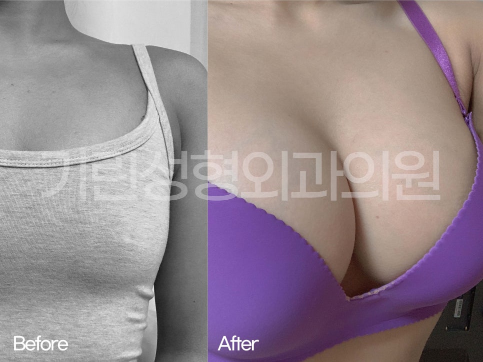 가슴성형전후 비교가 필요하다면 관련 이미지 1