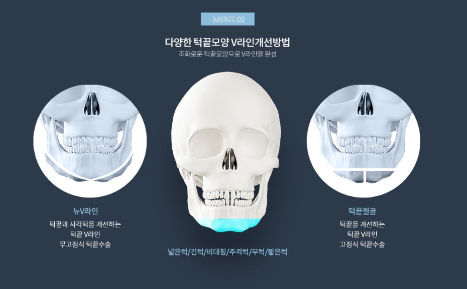 [사각턱축소 최다수술 이승룡원장] 태국에서 온 그녀의 윤곽 수술 후기 리얼 스토리&hearts; 관련 이미지 11
