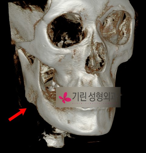 귀뒤사각턱 재수술사례 (한번에 자르지 않고 갈아낸 경우) 관련 이미지 2