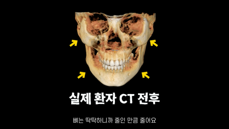 [기린성형외과]성형해도 답 없는 얼굴 _긴얼굴편 관련 이미지 7