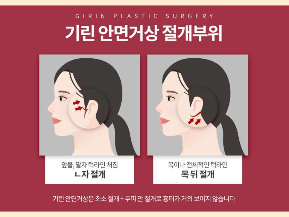 안면거상수술 효과 확실하려면 관련 이미지 13