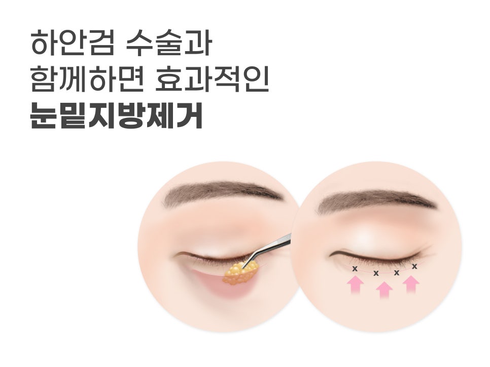 중년눈수술 어려지는 방법 중 하나? 관련 이미지 10
