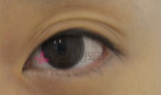 졸린눈 교정 비절개눈매교정! 관련 이미지 1