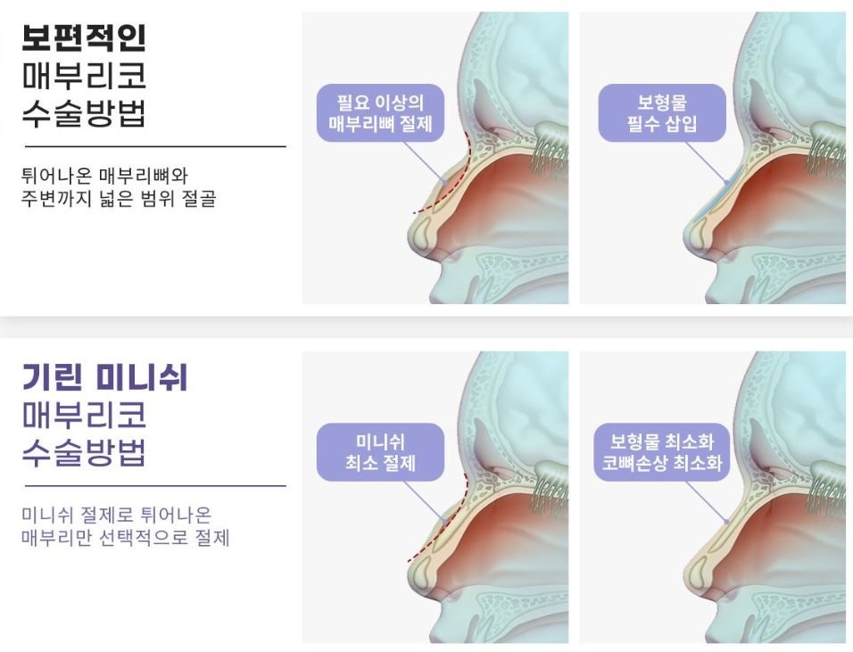 매부리코수술? 콧대만 깎는다고 해결 될까? 관련 이미지 3