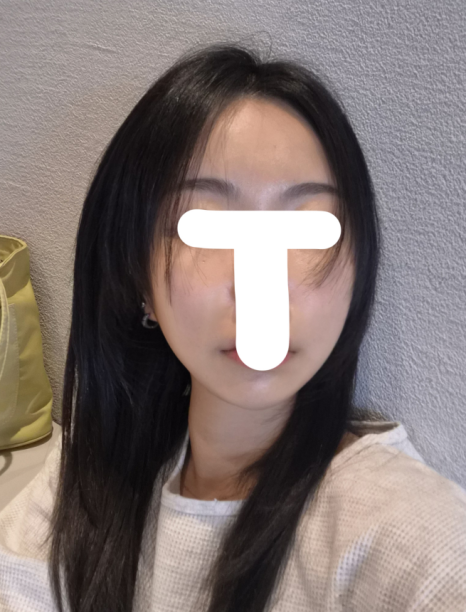 연조직윤곽술 후기, 볼살보다 신경 쓰였던 턱선 변화 관련 이미지 3