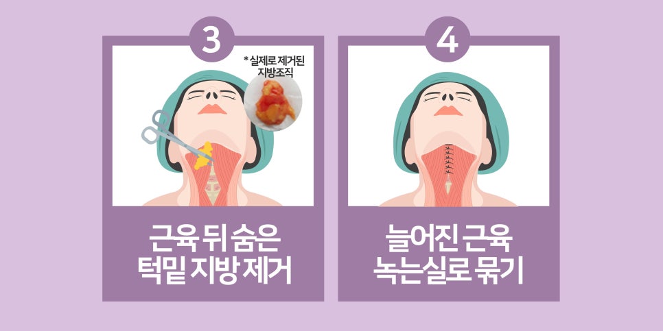 강남이중턱지방흡입 체크할 것 관련 이미지 12