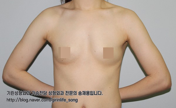 [가슴확대성형] 75A에서 75C로, 모티바 보형물을 이용한 가슴 확대 수술 케이스 관련 이미지 2