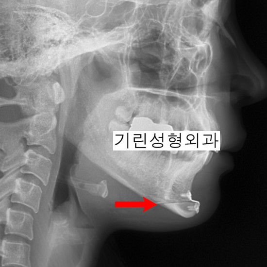 턱이 길거나 발달이 부진한 경우 적합한 턱끝수술 관련 이미지 2