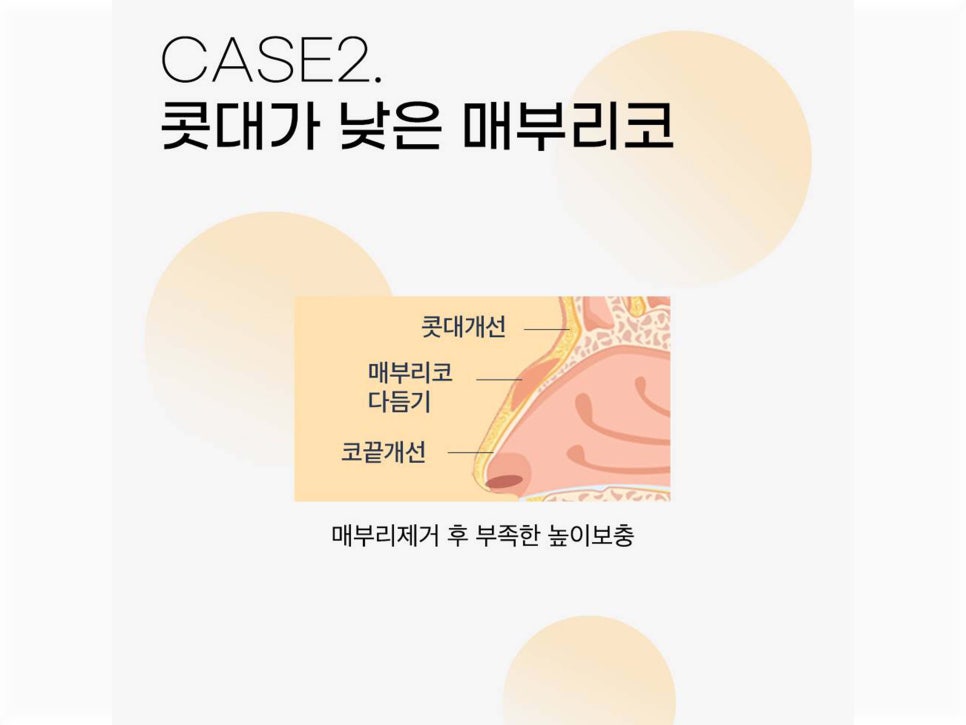 매부리코수술후기 올바른 라인으로 관련 이미지 10
