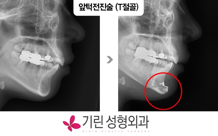 기린성형외과 앞턱수술(T절골을 이용한 앞턱전진술) 관련 이미지 1