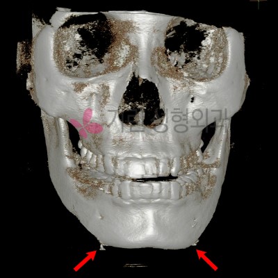 사각턱 후 비대칭이 된 수술부작용사례 : 이차각과 비대칭 관련 이미지 1