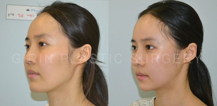 턱길이줄임+브이라인+광대고정술 16일/30일 경과 관련 이미지 4