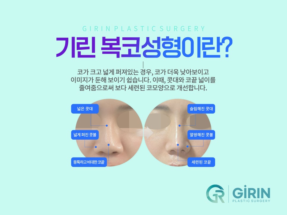 콧볼축소술 뭉툭한 코 개선을 위해 관련 이미지 3