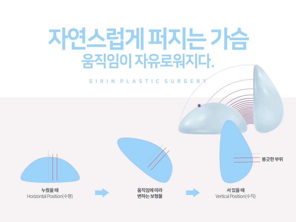 모티바가슴성형후기 신중하게 살펴보고 관련 이미지 7