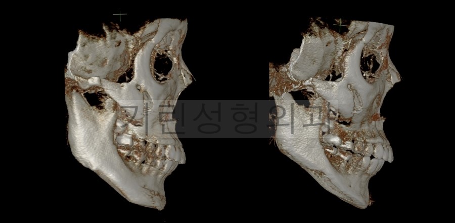 [브이라인재수술사례] 이차각제거 & 광대재수술이 필요없는 이유 관련 이미지 3