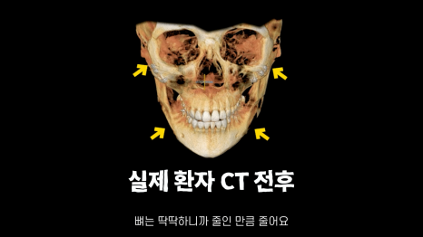 [기린성형외과]성형해도 답 없는 얼굴 _긴얼굴편 관련 이미지 8