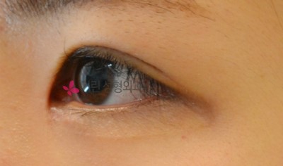 쌍꺼풀수술 전과 후 붓기비교(3달 반 경과) 관련 이미지 2