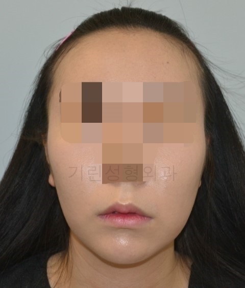 광대뼈고정, 볼처짐 아큐스컬프 사례입니다. 관련 이미지 6