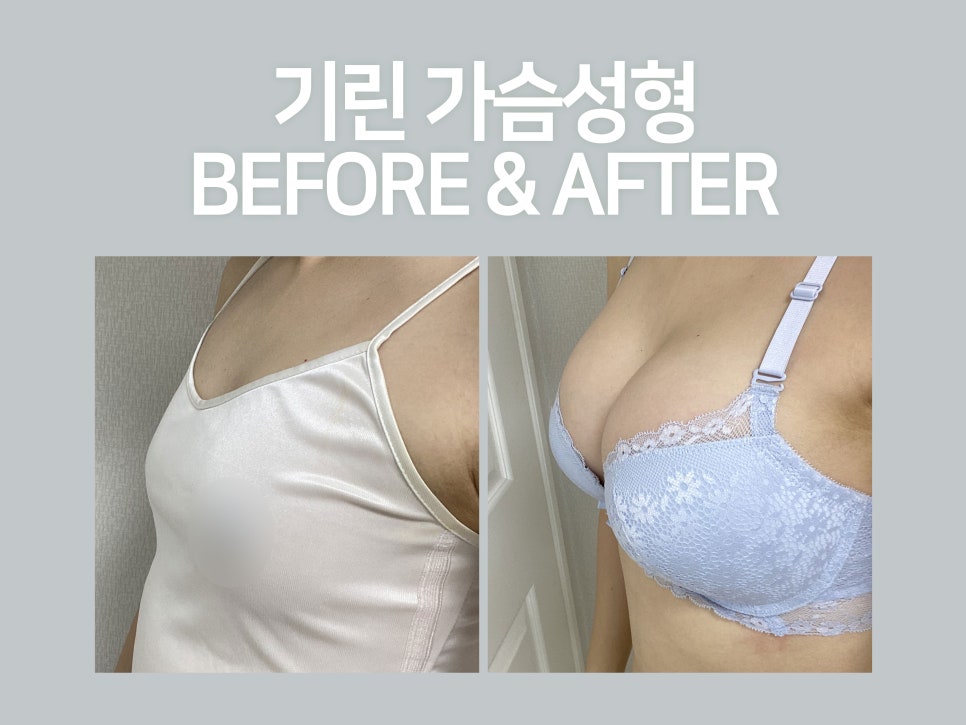 강남가슴성형 자연스러움이 기준 관련 이미지 1