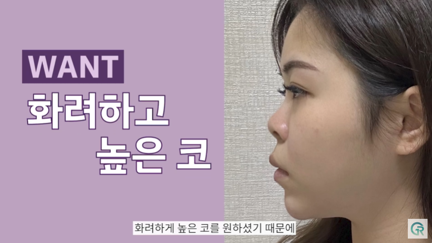 [기린성형외과] 짧고, 들린 코 탈출!_코성형 수술일지 관련 이미지 7