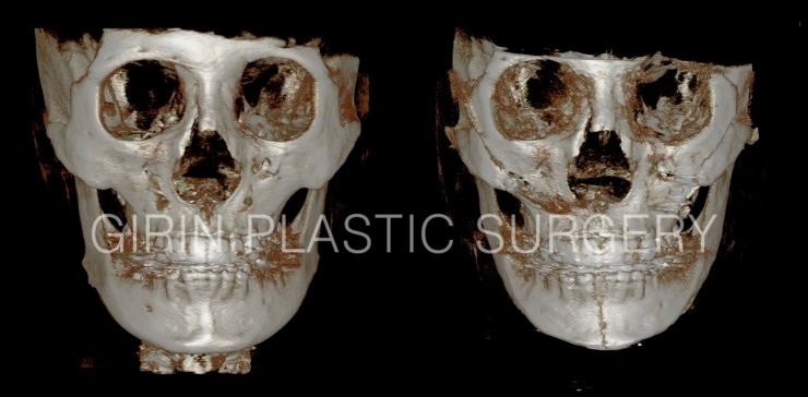 턱길이줄임+브이라인+광대고정술 16일/30일 경과 관련 이미지 5