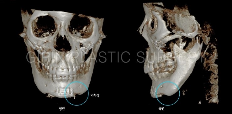 티절골 후 이차각으로 재수술이 필요한 사례 관련 이미지 3
