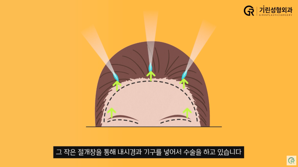 [기린성형외과] 어제보다 오늘 더 젊어지는 기린 이마거상_이마거상 Q&A 관련 이미지 7