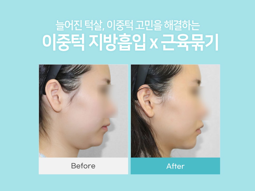 이중턱지방흡입 고려하고 있다면 관련 이미지 1