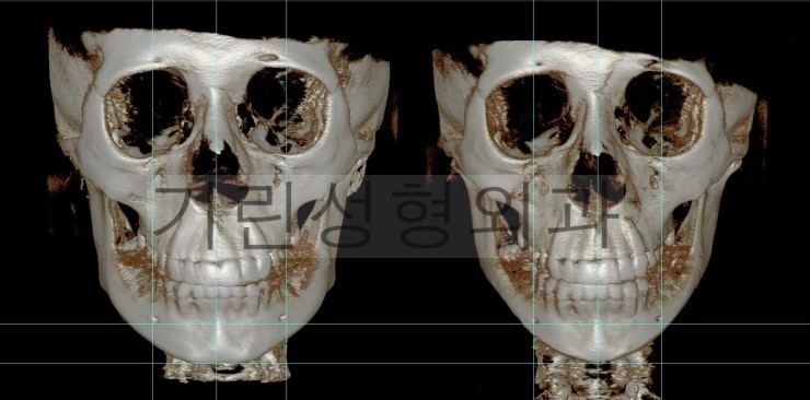 퇴원시 촬영한 긴곡선사각턱 CT영상/ 8일차 경과사진 관련 이미지 2