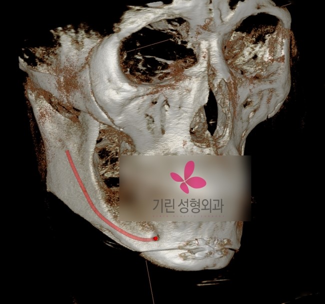 사각턱수술 신경선의 위치 관련 이미지 1