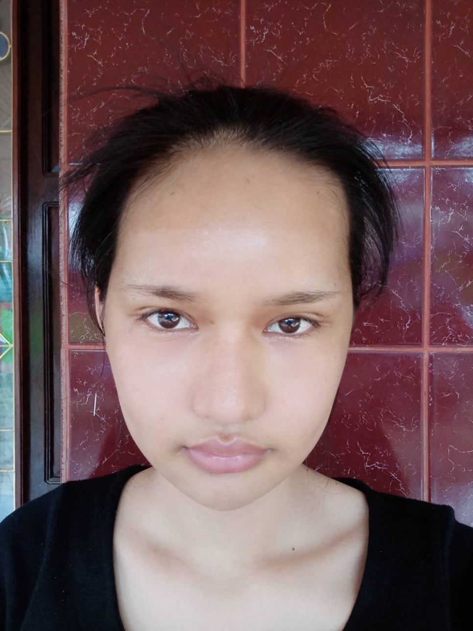 [사각턱축소 최다수술 이승룡원장] 태국에서 온 그녀의 윤곽 수술 후기 리얼 스토리&hearts; 관련 이미지 5